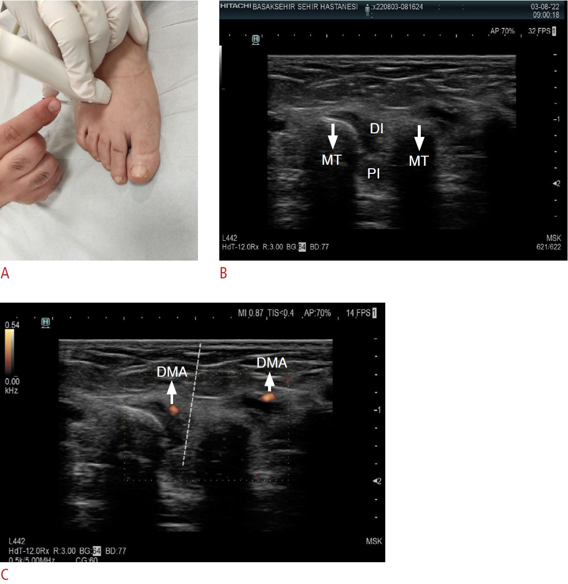 Musculos interoseos tempo formacion 2.jpg